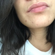 A close-up of my chin acne. Chacne? Chits? :(
